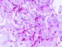 Esophageal candidiasis